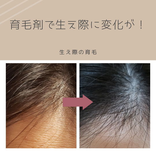 ママ生え際before　after
