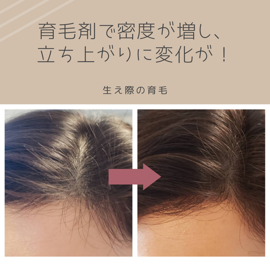 須永様生え際＆頭頂部before　after