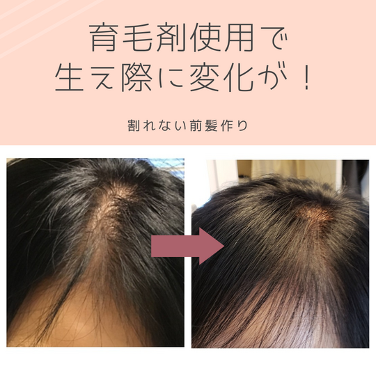 小林様生え際before　after